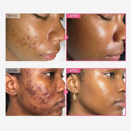 Alpha Arbutin + TXA Corrector cream