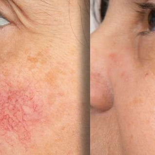 Apris - Anti-Redness Serum